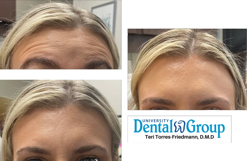 Botox before and after — forehead and frown lines, University Dental Group Orlando