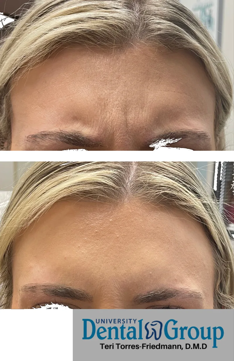 Botox before and after — glabella frown lines between the brows, University Dental Group Orlando