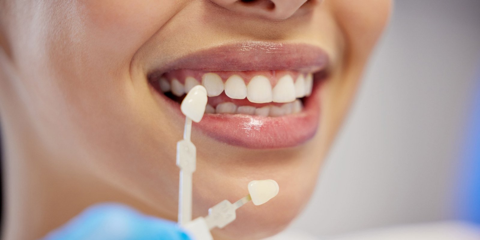 A brighter smile after stain removal at University Dental Group in Orlando Shade guide held against a patient's smile to compare tooth color at University Dental Group in Orlando, FL