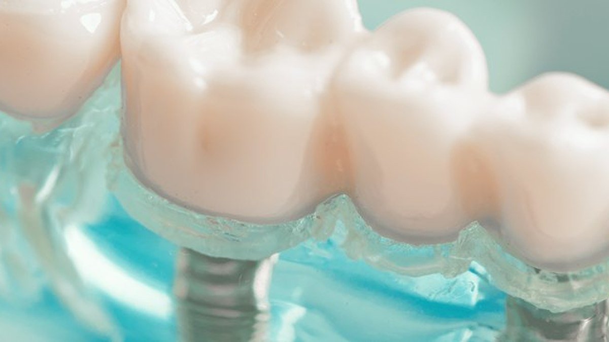 Dental models comparing a dental implant and a fixed dental bridge Side-by-side dental models comparing a single dental implant and a fixed dental bridge