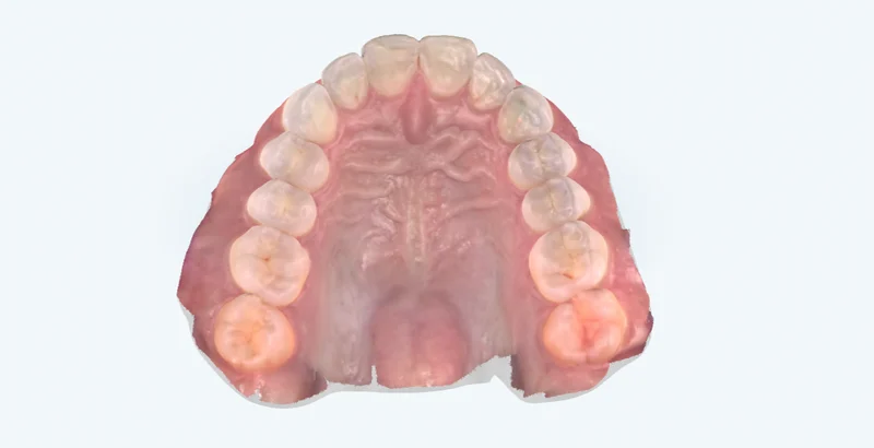 3D intraoral scan — upper arch, University Dental Group Orlando