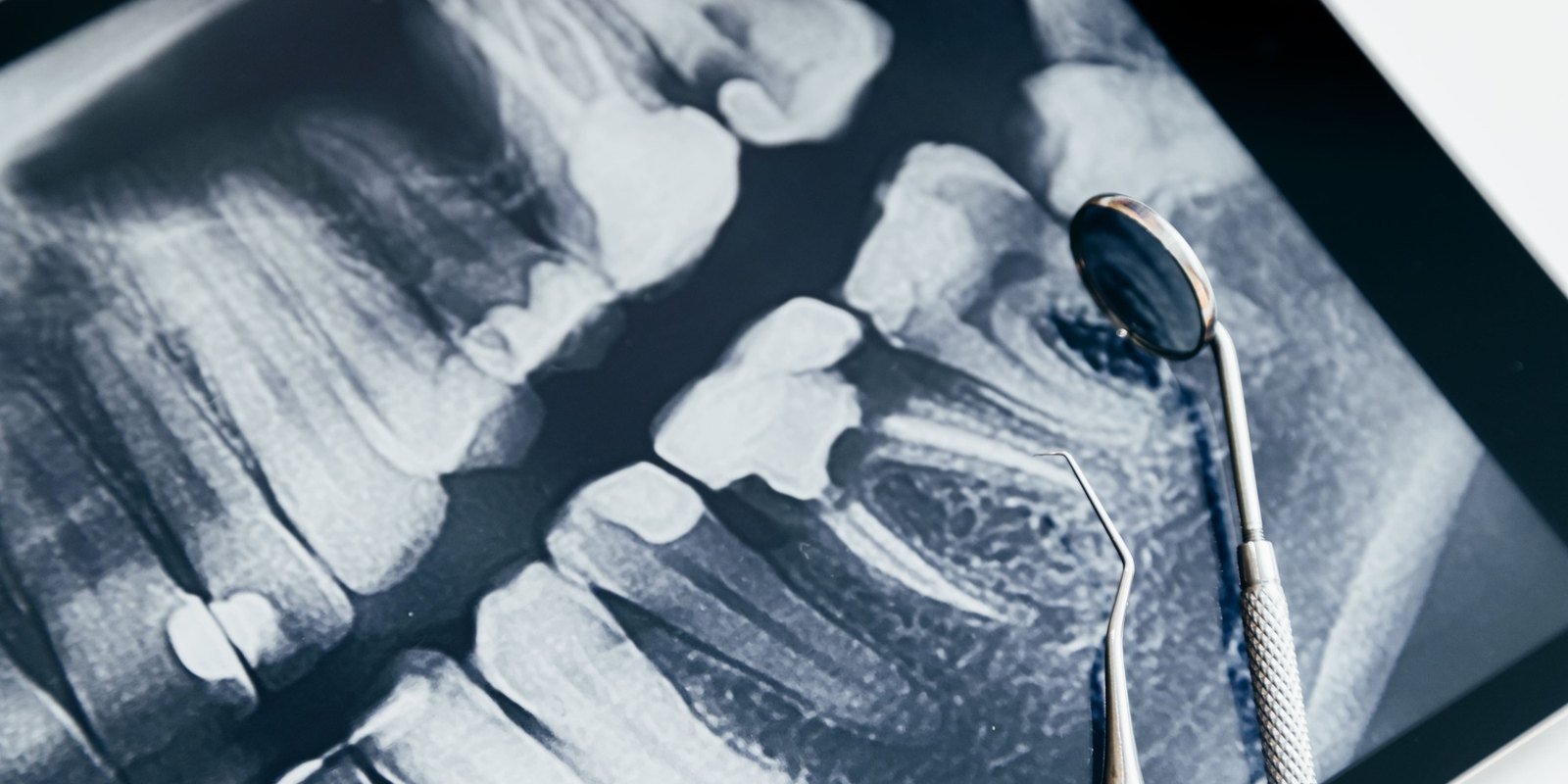Reviewing dental x-rays with a patient at University Dental Group in Orlando Digital dental x-ray on a tablet beside a mirror and explorer at University Dental Group in Orlando, FL
