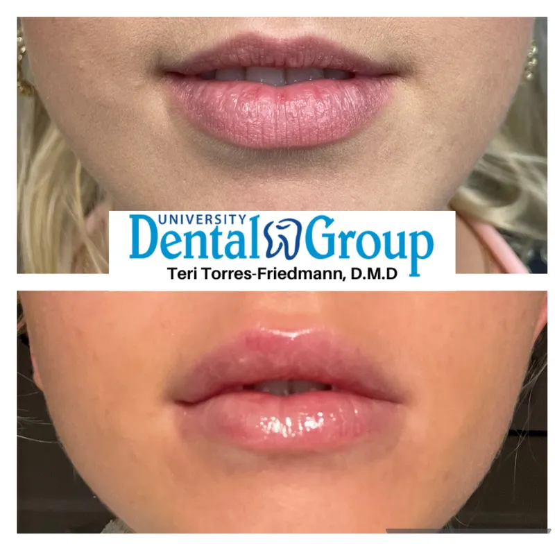 Lip filler before and after — Versa hyaluronic-acid lip enhancement, University Dental Group Orlando