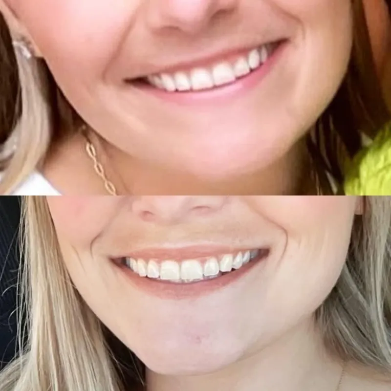 Lip flip before and after — softer, more balanced smile, University Dental Group Orlando