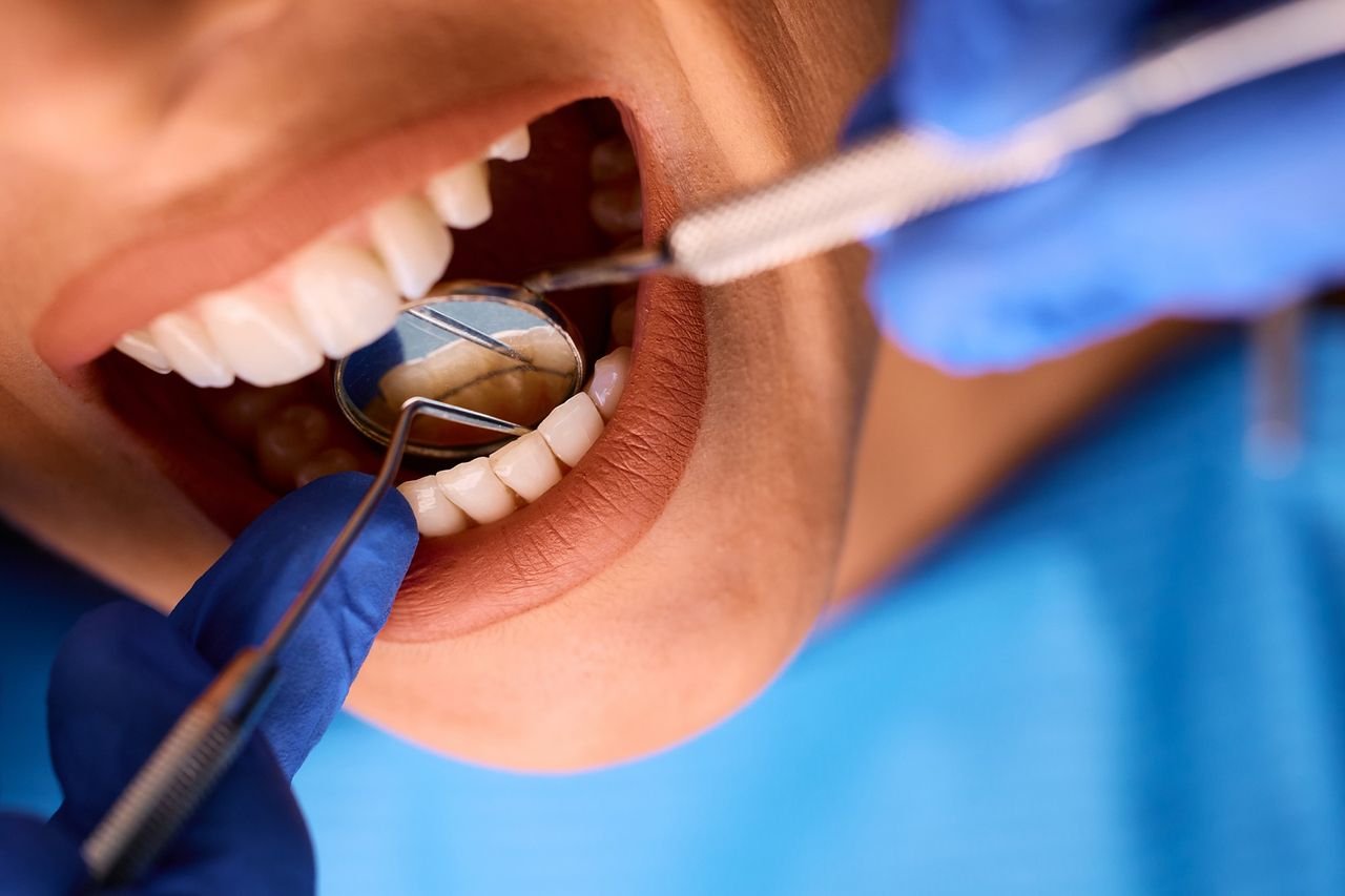 Only a professional cleaning removes tartar Dentist checking a patient's teeth with a dental mirror and probe