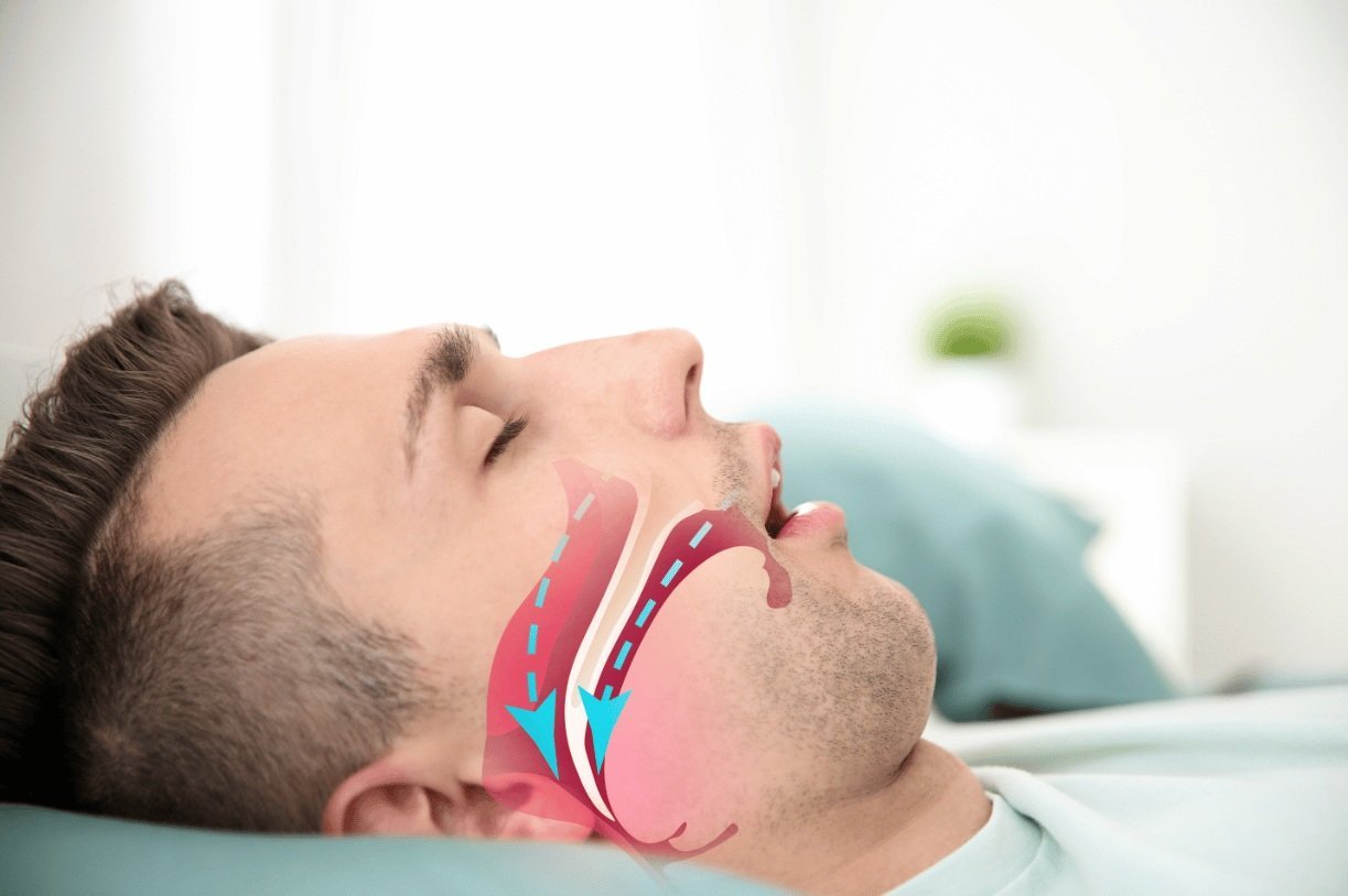 Dental sleep medicine