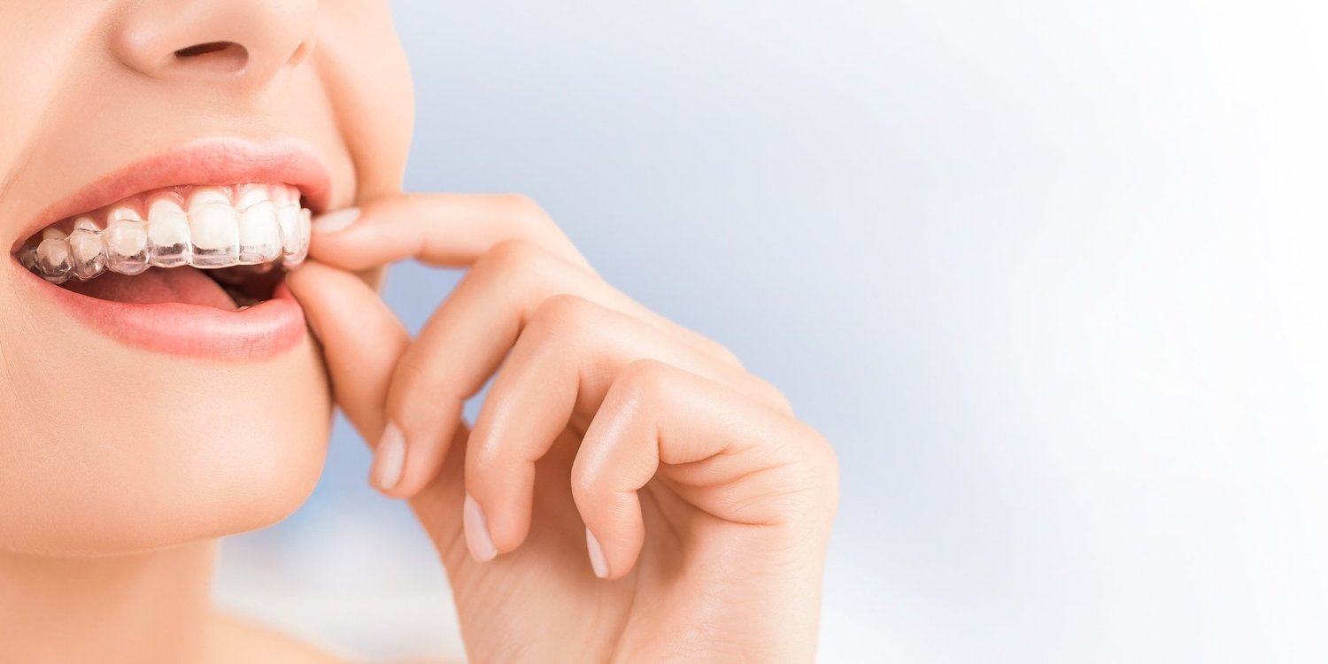 Invisalign clear aligners