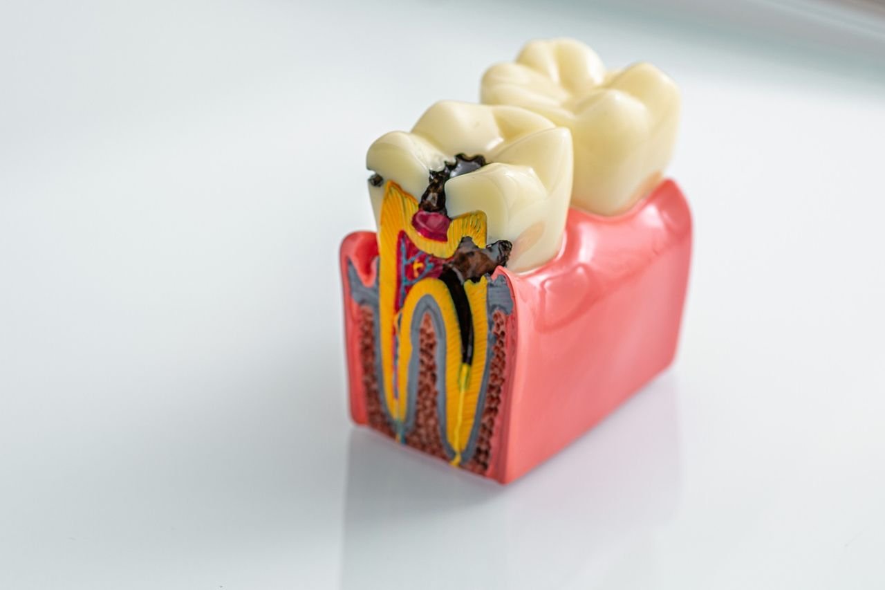 Dental model showing how tooth decay progresses through the layers of a tooth