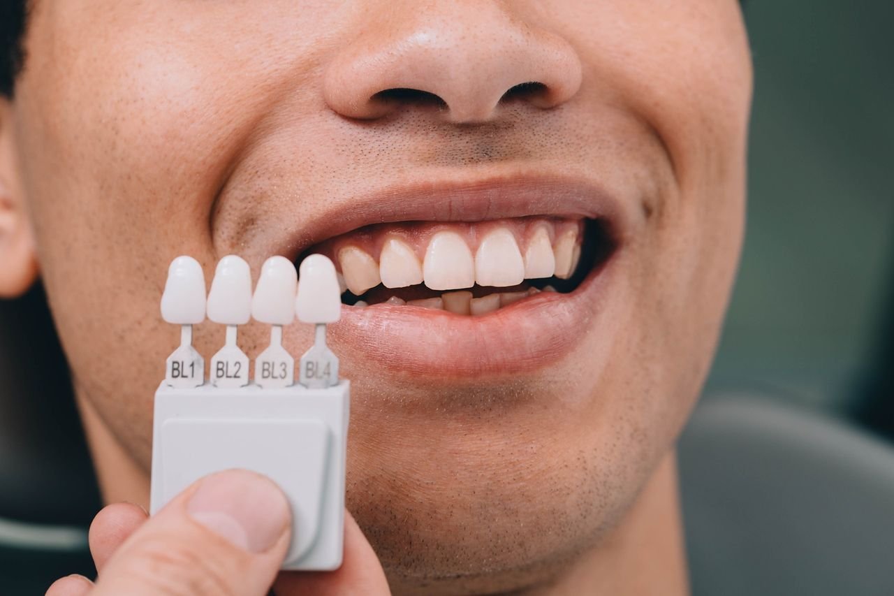 Dentist comparing tooth shades for veneers against a patient's smile at University Dental Group